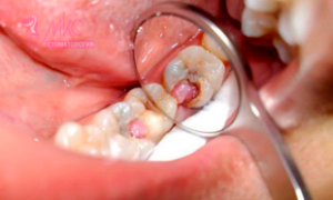 фото лечение пульпита зуба