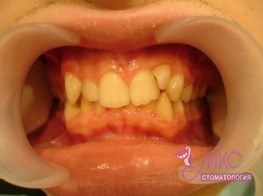 фото до ортодонтического лечения зубов