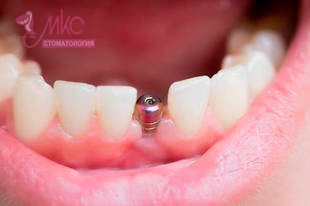 фото установка импланта зуба