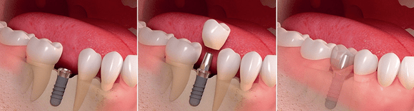 фото имплантация зуба в стоматологии