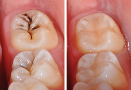 фото лечение кариеса зубов в стоматологии