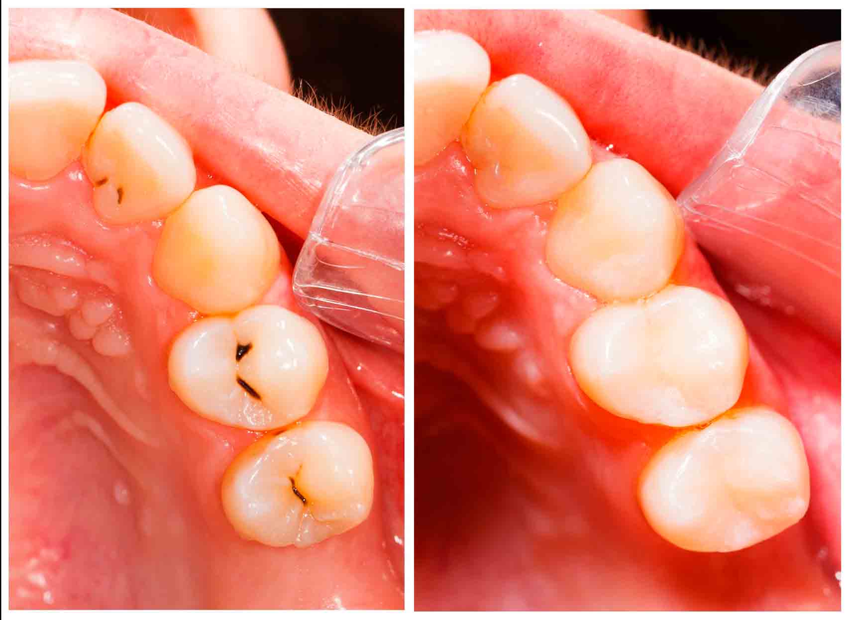 фото лечение глубокого кариеса зубов