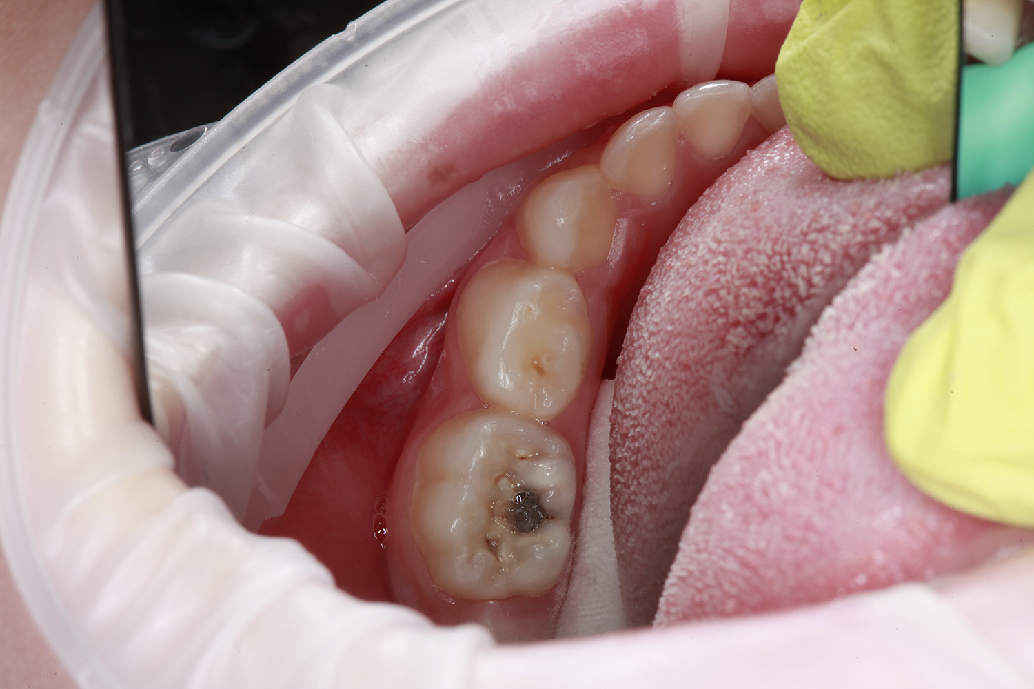фото лечение пульпита зуба стоматологии